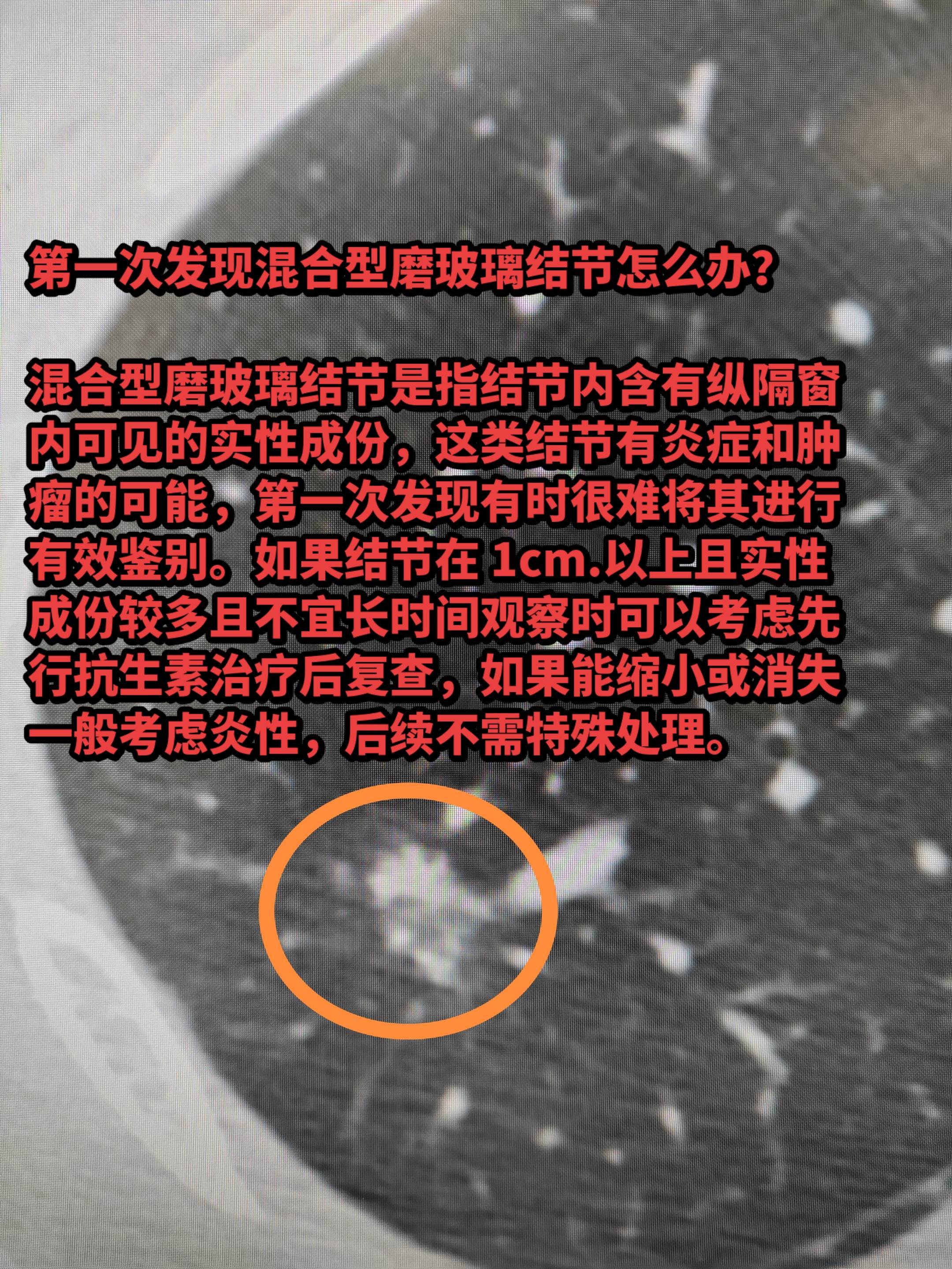 第一次发现混合型磨玻璃结节怎么办？混合型磨玻璃结节是指结节内含有纵隔窗...