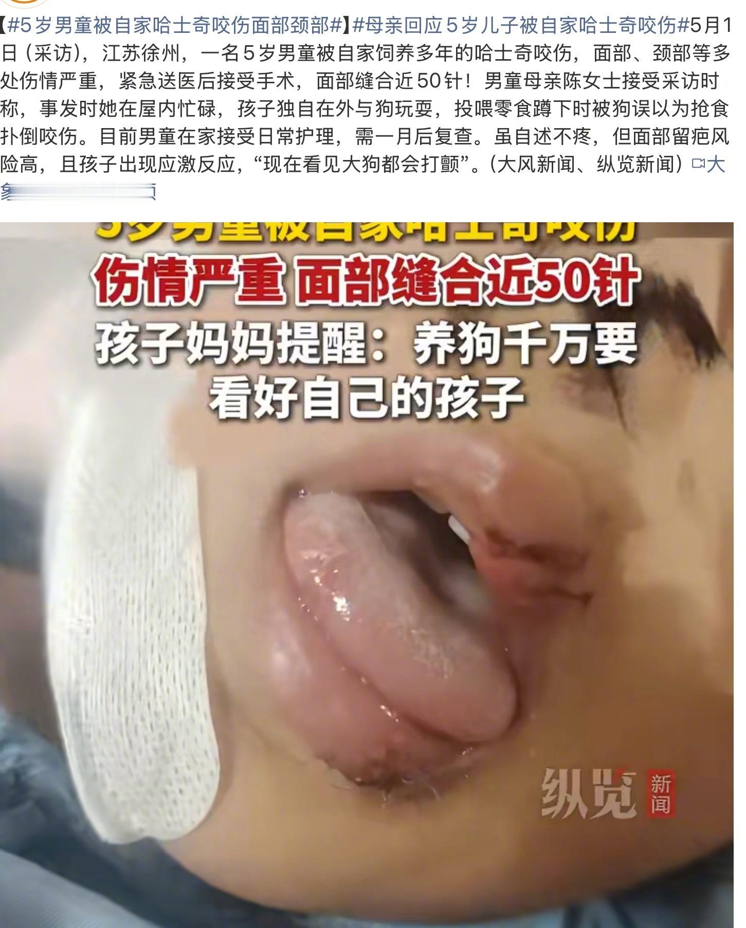 5岁男童被自家哈士奇咬伤面部颈部看到这条新闻，作为养狗的人心里很不是滋味。心疼小