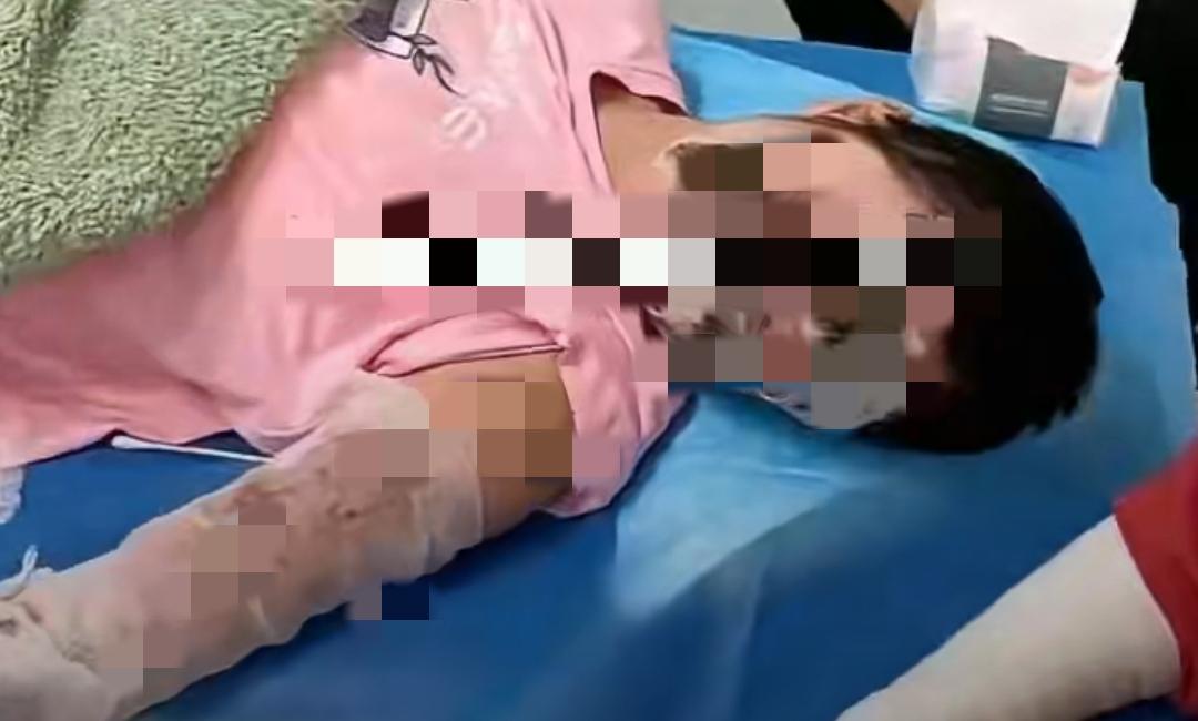 枕边彻夜充电=埋定时炸弹！
湖北女子70%烧伤，
这些充电雷区你天天踩？
赶紧把