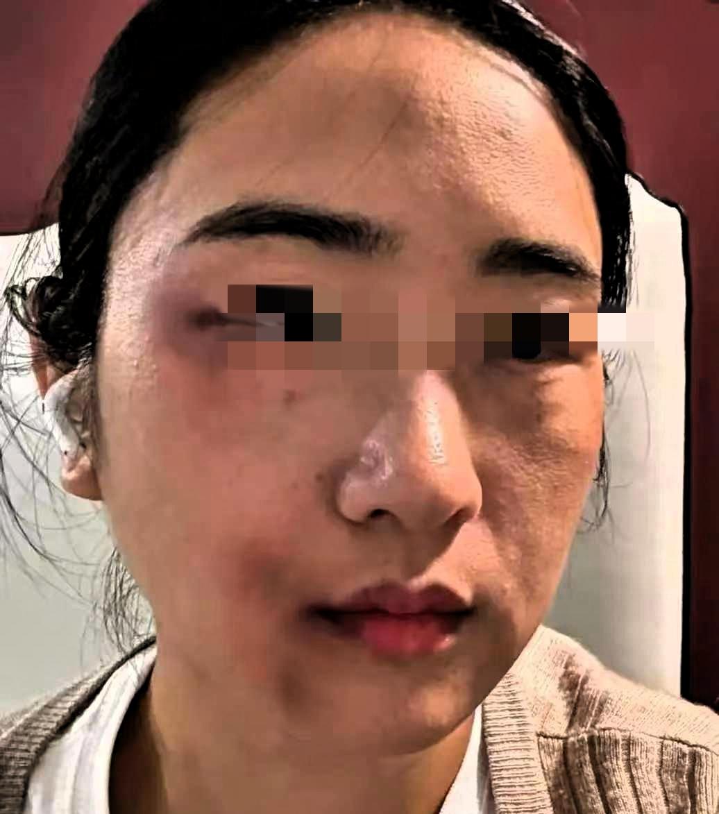 孕36周的准妈妈被丈夫一脚踹在腰侧，没哭没闹，转头去医院开了病历直奔派出所。她说