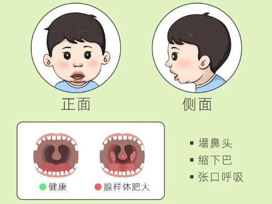 腺样体肥大害怕的，从来不是手术切除，而是这点！找准方法调体质，孩子一天比一天好！