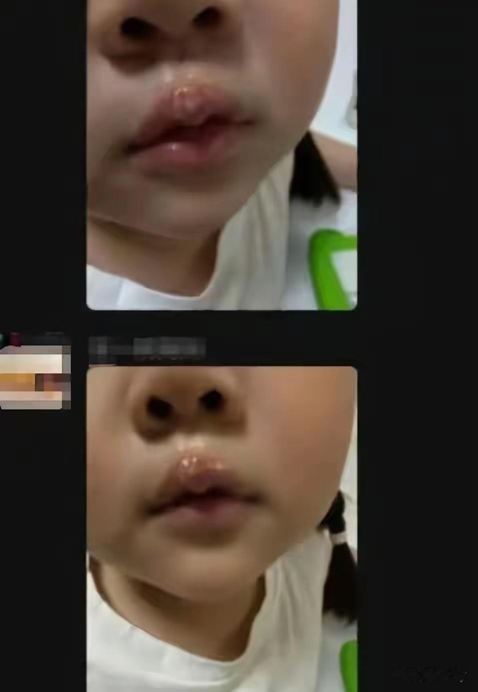 如果不是家长非要调取监控不知还要有多少孩子遭殃！

江苏丰县，一家长发现孩子嘴唇