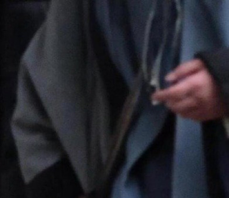 杨洋的手好肿有没有学医的吃瓜路，你们看看，一个月就让人拆掉固定板，这合理吗啊啊啊