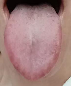 肾阳虚衰兼痰瘀阻滞，男士体质舌诊辨证与调养思路






有粉丝倾诉：年少时未