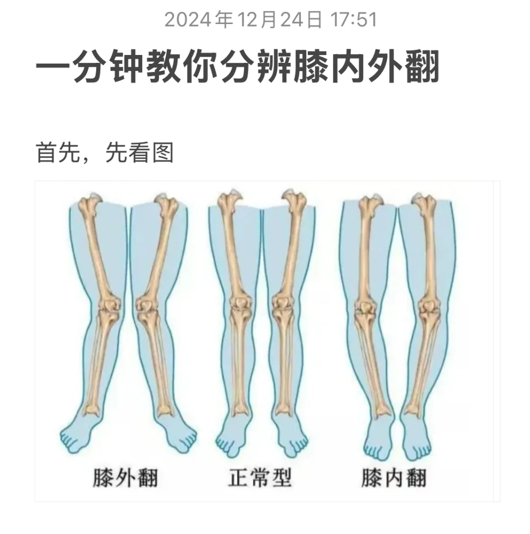 一分钟快速分辨膝内外翻