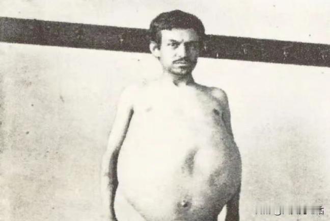 “他是被屎憋死的。”1940年，美国人约翰由于便秘，三年没排泄，不幸去世，医生的