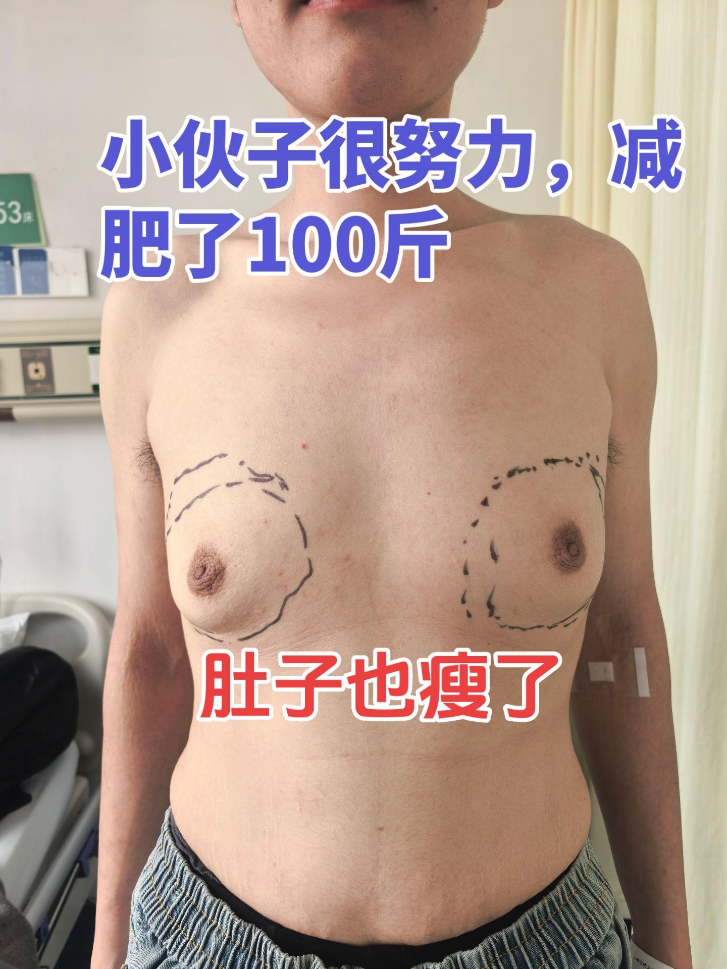 男性乳房发育微创手术 门诊经常 看到很多胖胖的初中生或者高中生 很多乳...