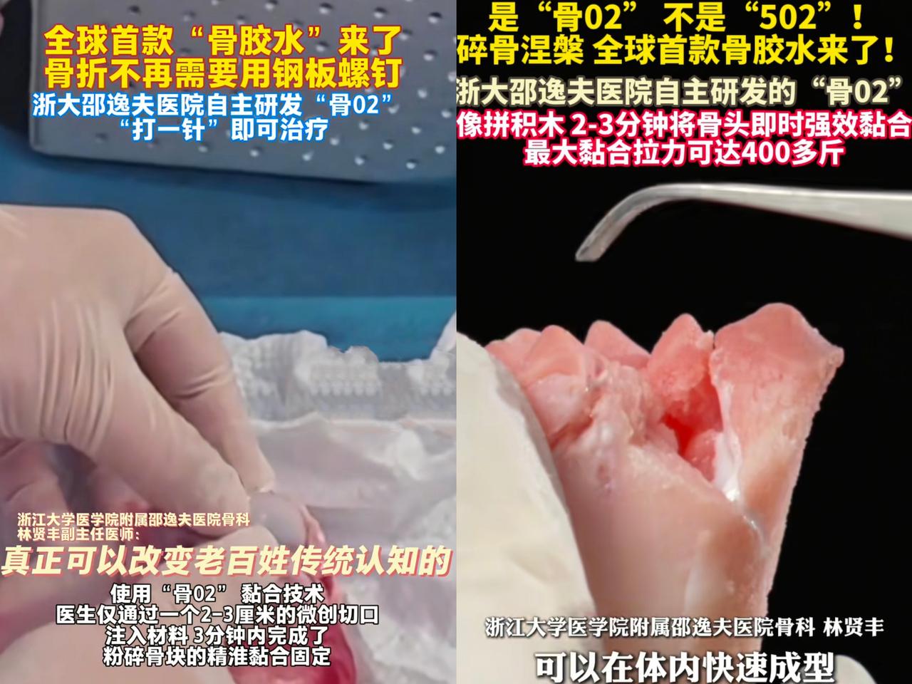 这下可真出名啦，不光咱中国，全世界都得知道浙江邵逸夫医院搞出个大宝贝——全球首款