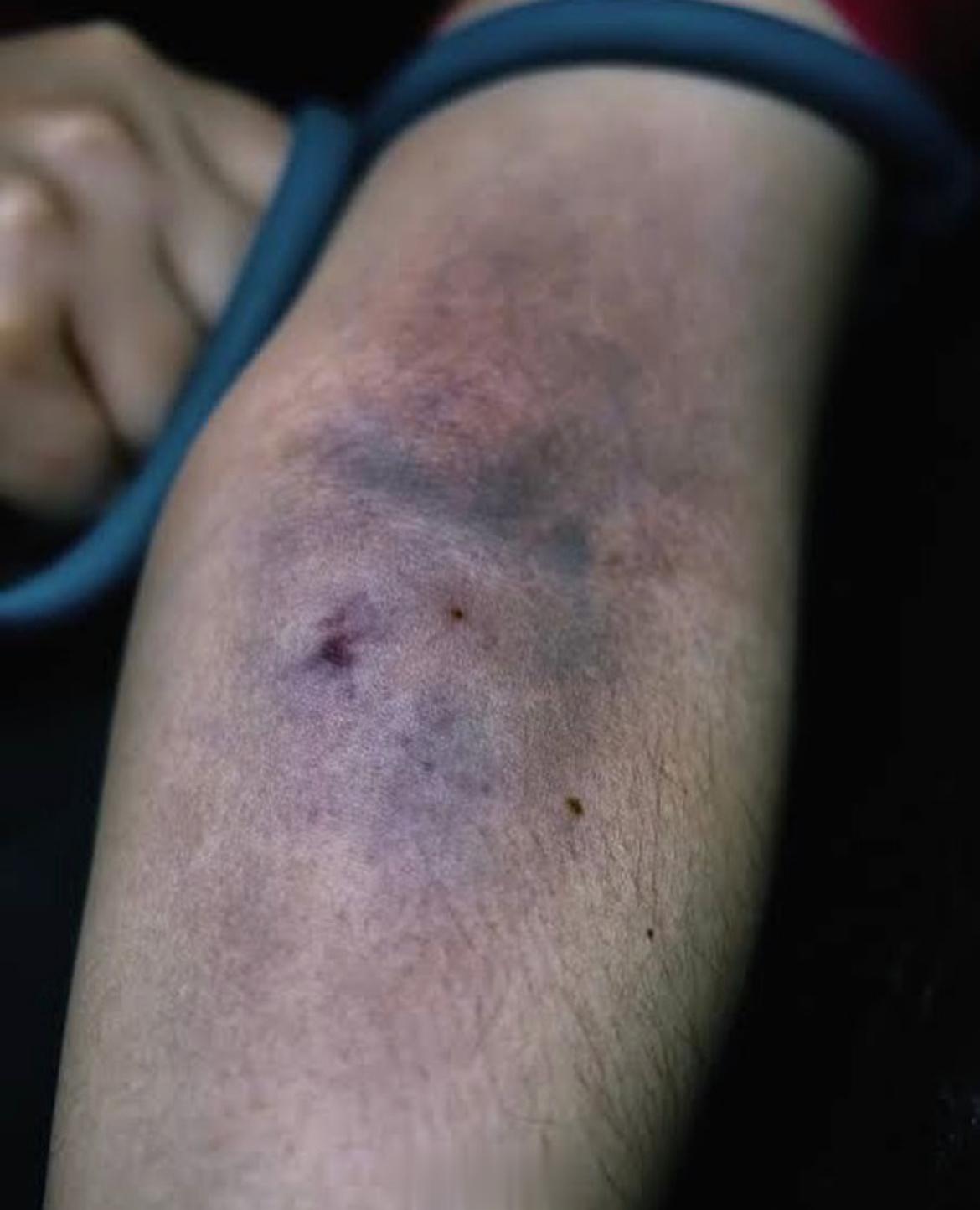 患者，35 岁，HIV+（艾滋病毒携带者），静脉吸毒时出现癫痫持续抽搐状态，送往