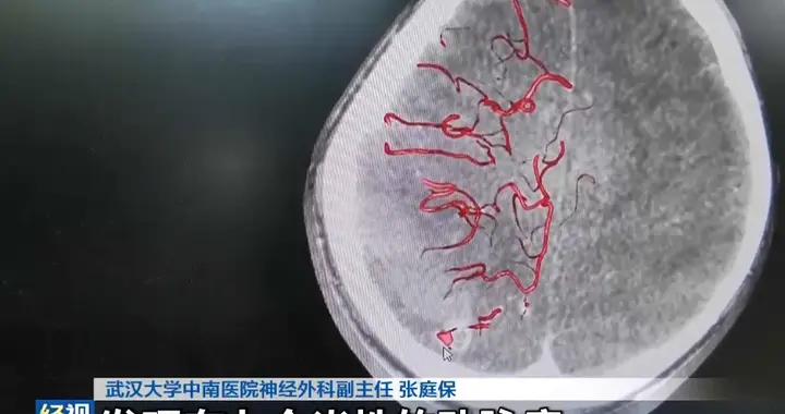 10岁男孩徒手拔烂牙，几个月后突发大量脑出血！医生：口腔感染入血，一路侵袭心脏瓣膜，攻入大脑....