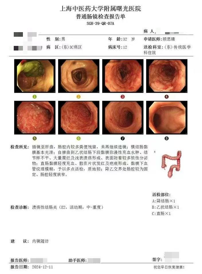 破解难治性溃疡性结肠炎的关键三要素。便血两月未止，依从治疗终见曙光 这...