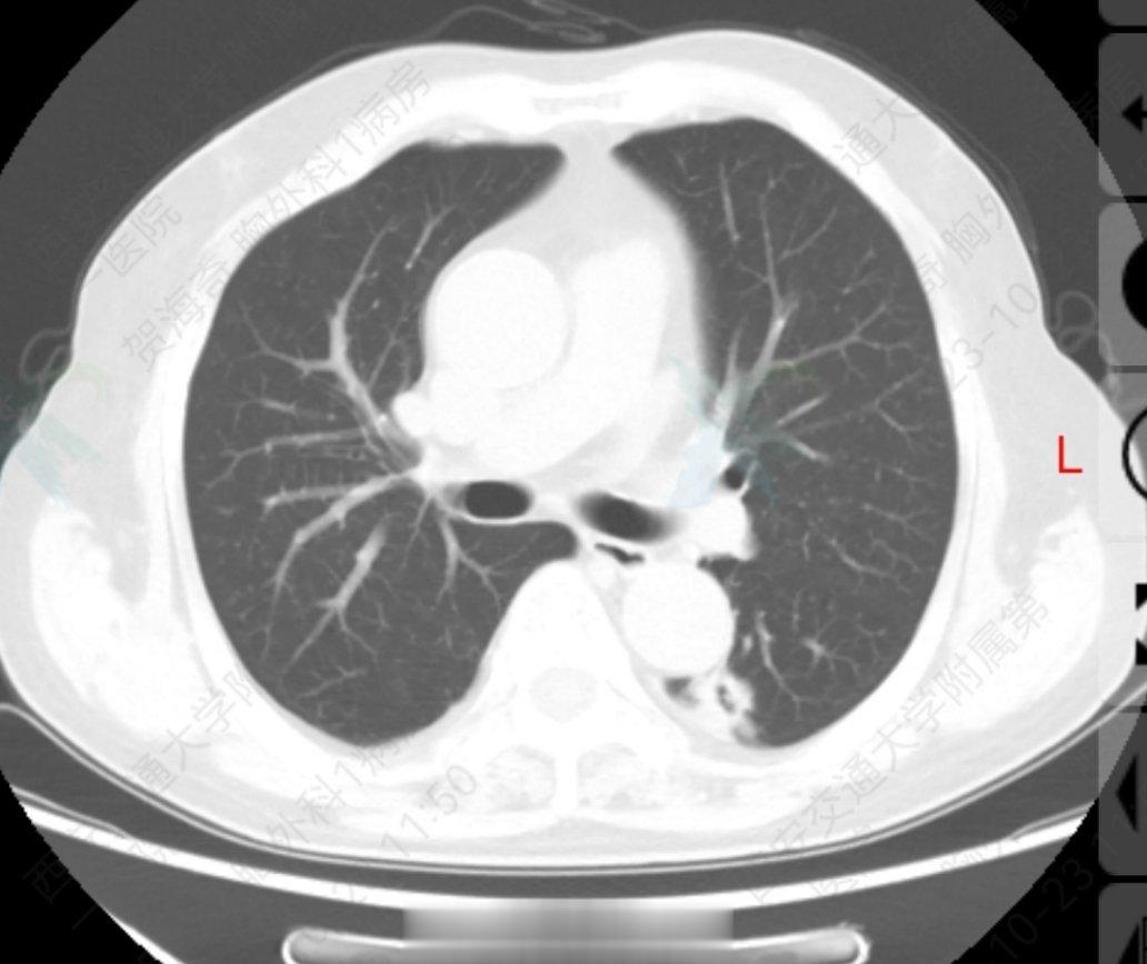 又是一例长期稳定的恶性#肺结节# 。病人体检发现肺部空洞型占位，内部有点状钙化灶