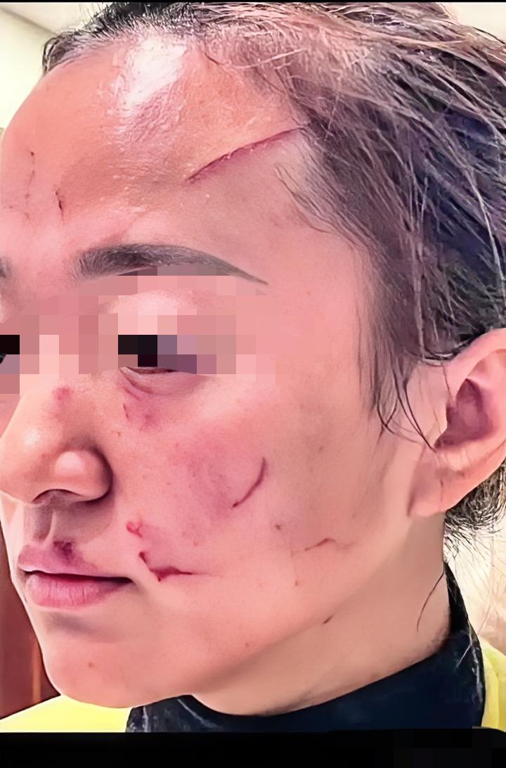 婆婆把儿媳脸挠得快毁容，就为了孩子打闹这点破事，这哪是长辈，分明是没分寸！拿5万