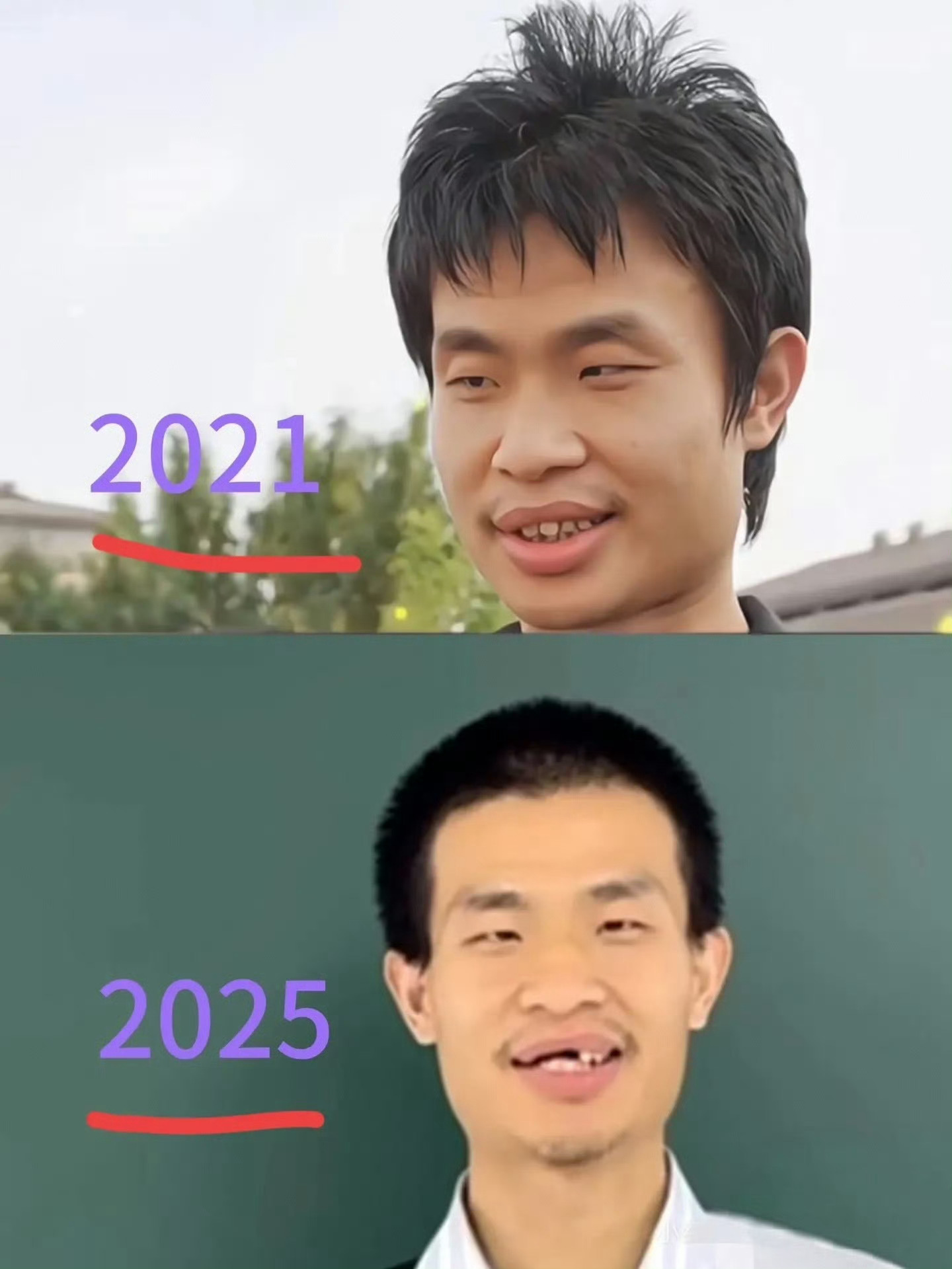 北大将帮韦东奕积极治疗听说牙周炎也可能是遗传，另一方面就是口腔卫生引起，还有人说