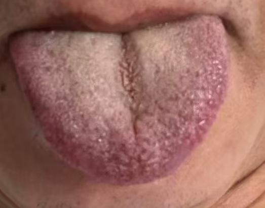 肝郁脾虚痰湿重，气血不通致宗筋失养







一位粉丝留言疑惑，自己坚持戒养