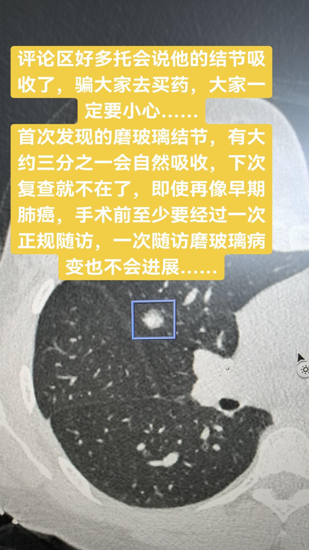 首次发现的肺磨玻璃结节约30%可能会吸收。评论区好多托会说他的结节吸收...