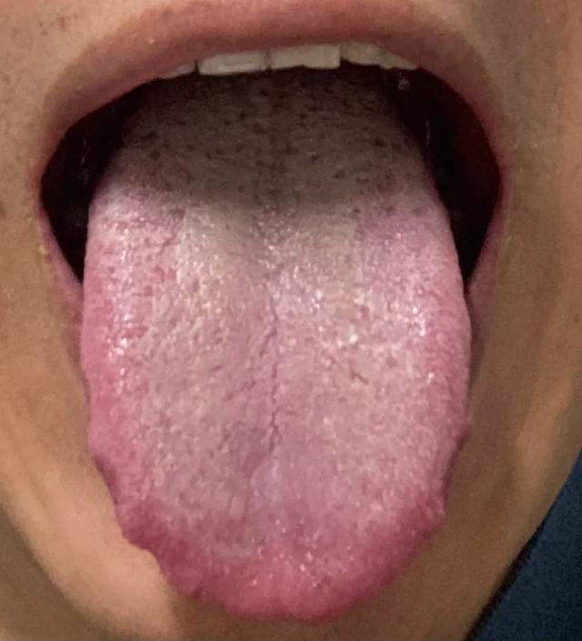 男同志的问题，主要还得看舌根！
 
大家看一下这个舌象，舌根黄腻，典型的下焦湿热