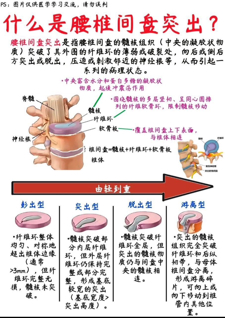 什么是腰椎间盘突出   医学科普 ​​​