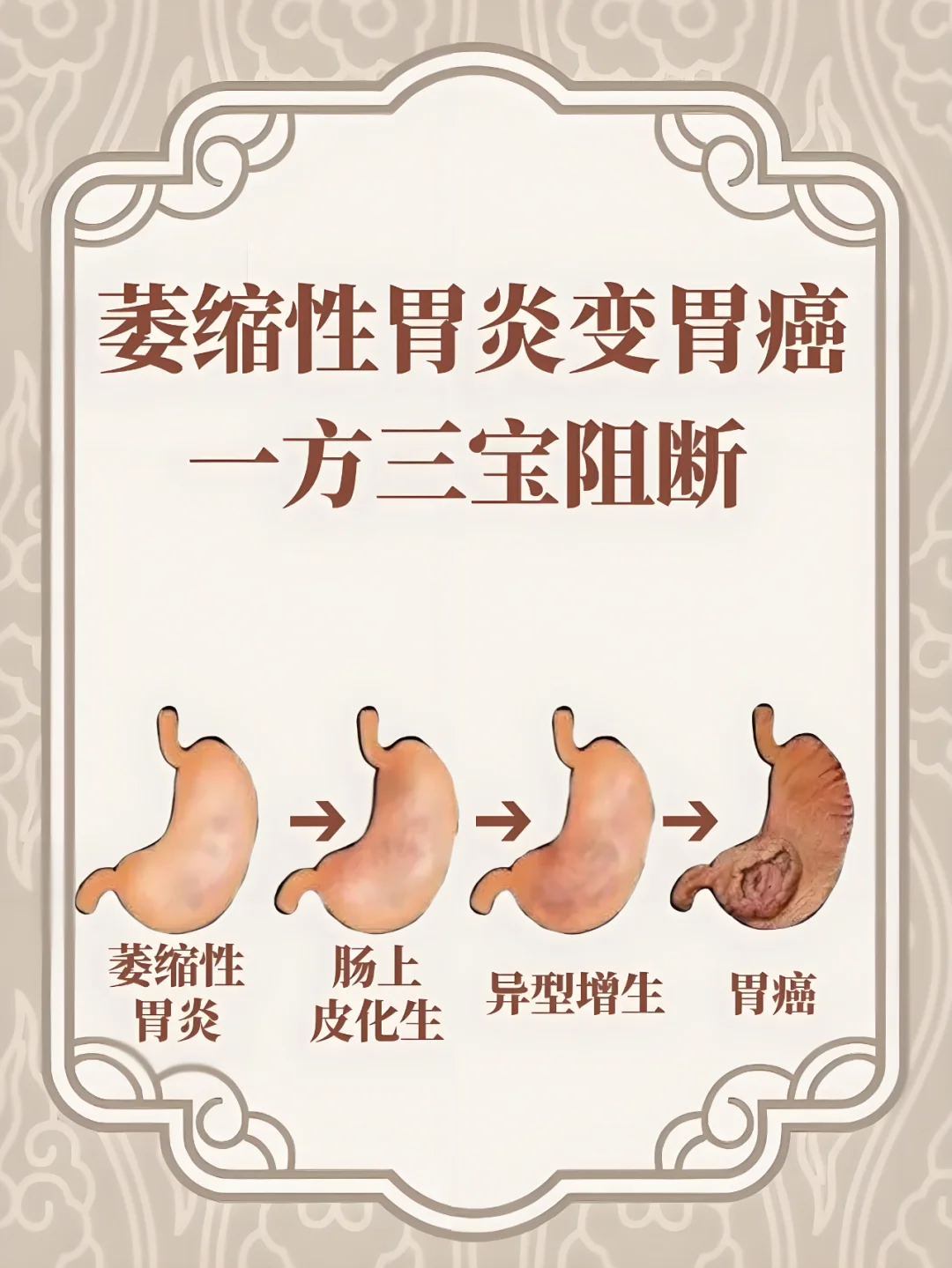 萎缩性胃炎变胃癌，一方三宝阻断！