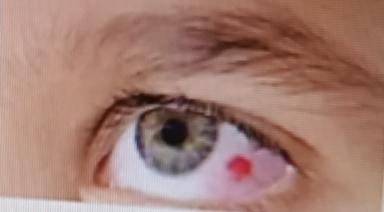 飞蚊现象和玻璃体混浊差别还挺大。飞蚊现象是患者主观感觉，像眼前有飘动的小黑影、点