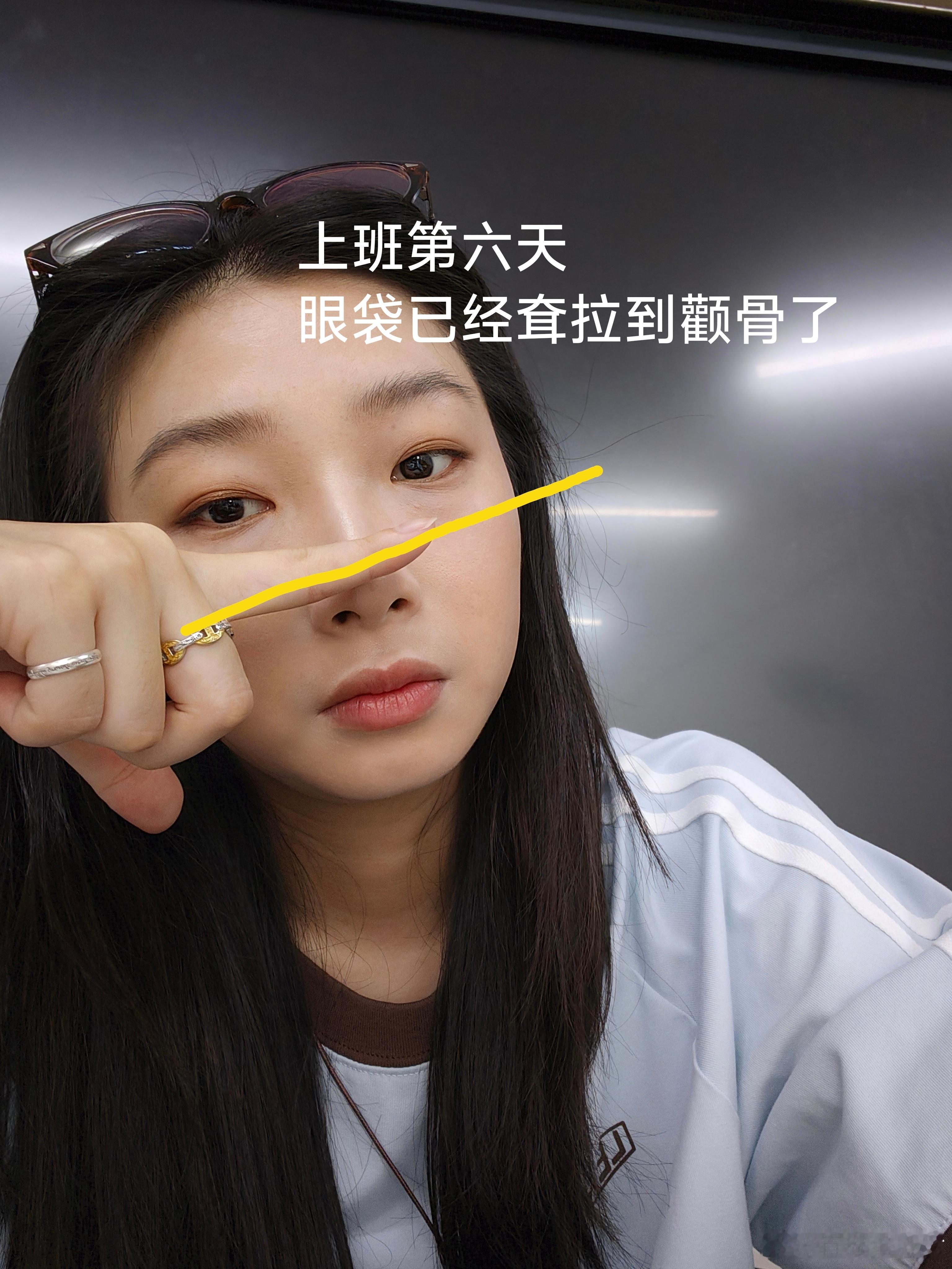 眼泪向下，眼袋向下，口角囊袋向下我上班 ​​​