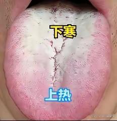 中医舌诊绝密私藏！全红舌用黄连阿胶、全白舌用小建中、两个都占用半夏泻心！​1.全