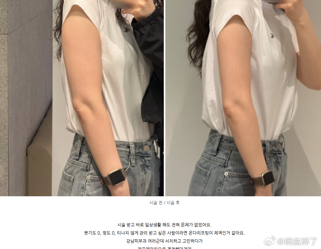 这是一次ONDA的效果。其实ONDA这个仪器本身哪里都能做，面部、双下巴、手臂、