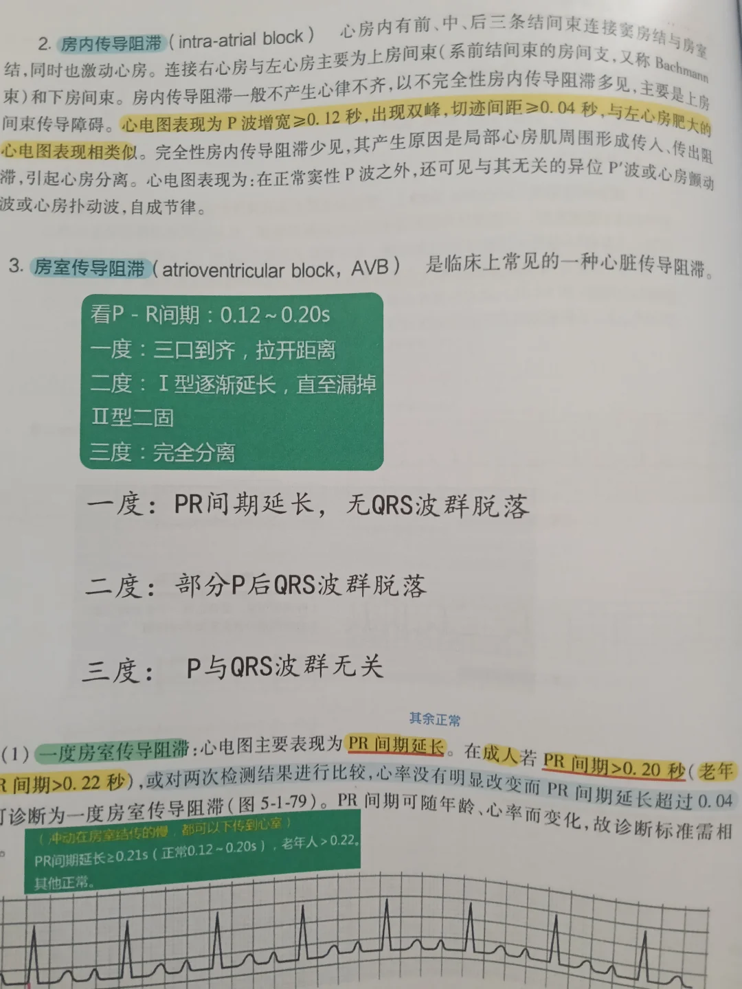心电图笔记：房室传导阻滞