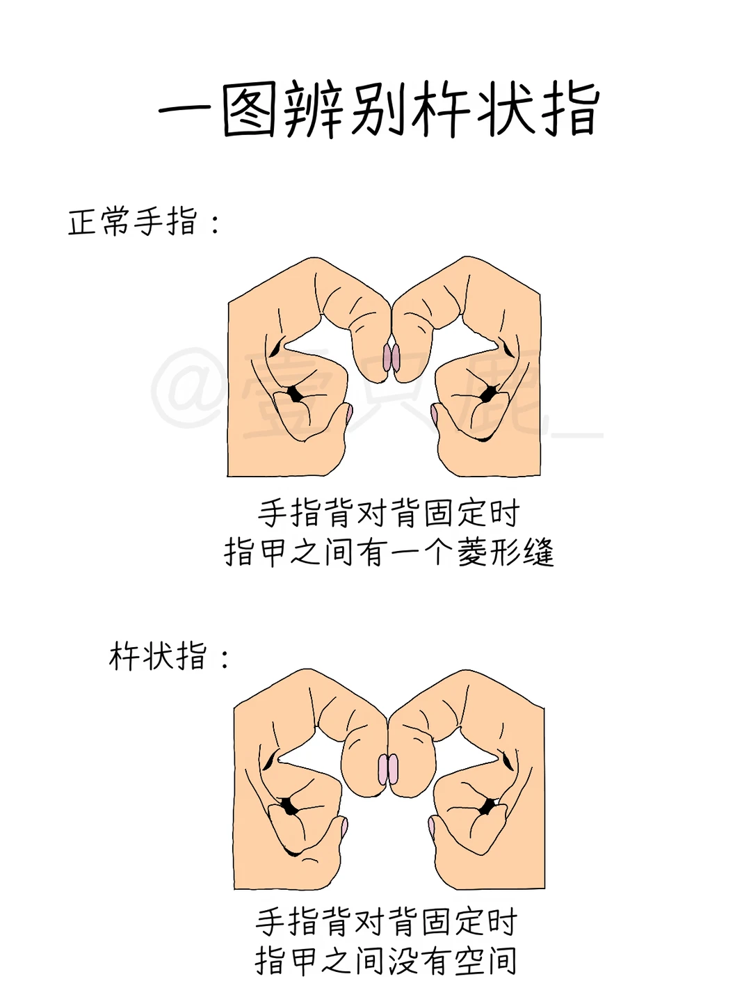 医学生笔记📝｜杵状指怎么看？