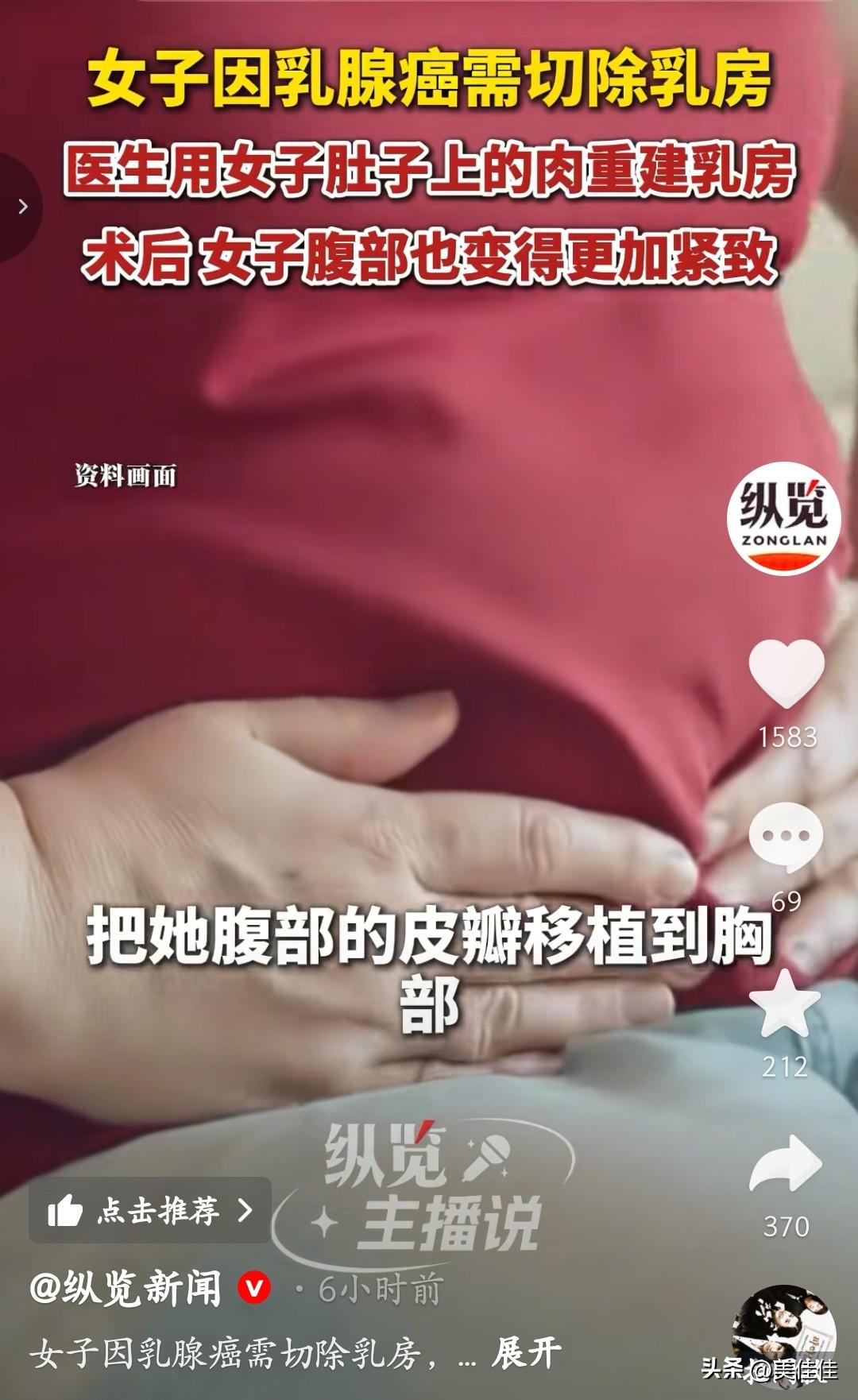 女子因乳腺癌切除乳房，没想到医生用肚子上的肉给女子做了个“胸”，肚子也变得比以前