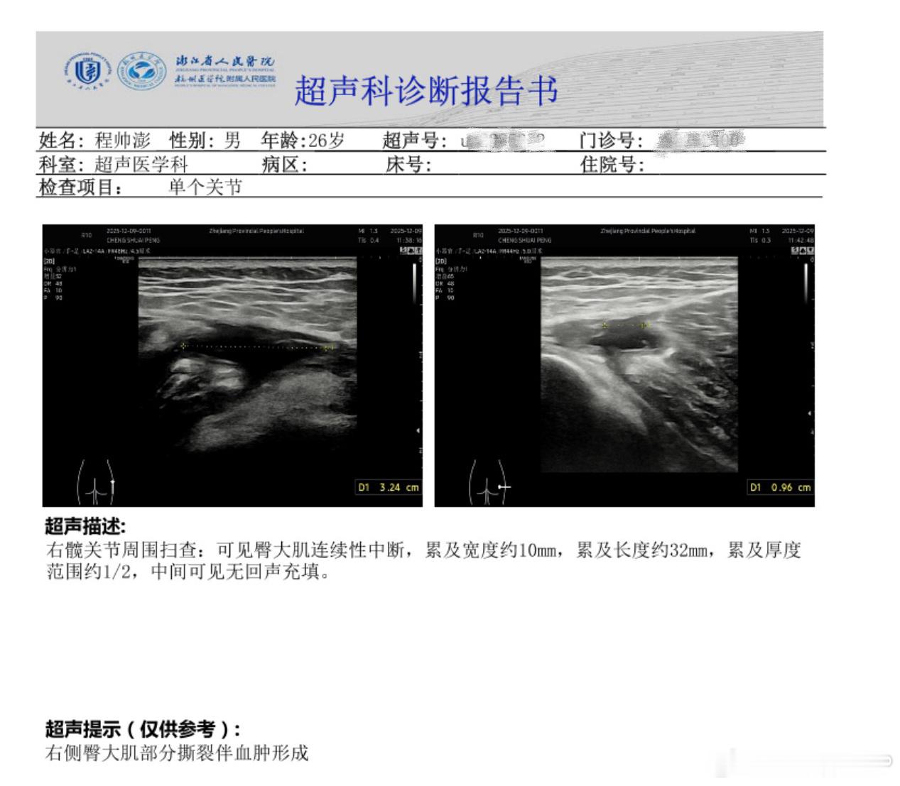 屋漏偏逢连夜雨，船迟又遇打头风。开赛遗憾遭遇三连败的浙江男篮官宣，国手程帅澎右侧