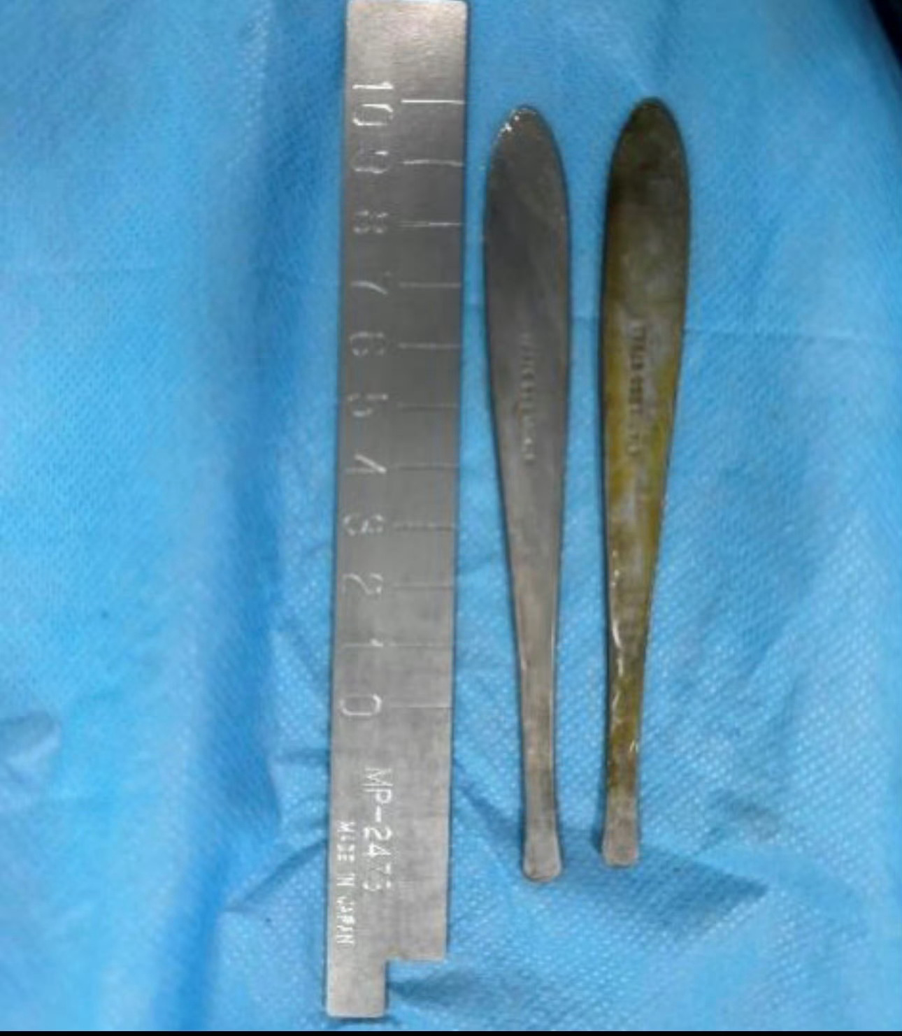 男子肚子疼查出肠道里有勺子，医生花了近一小时才取出来，好奇怎么吞进去的。小伙腹痛