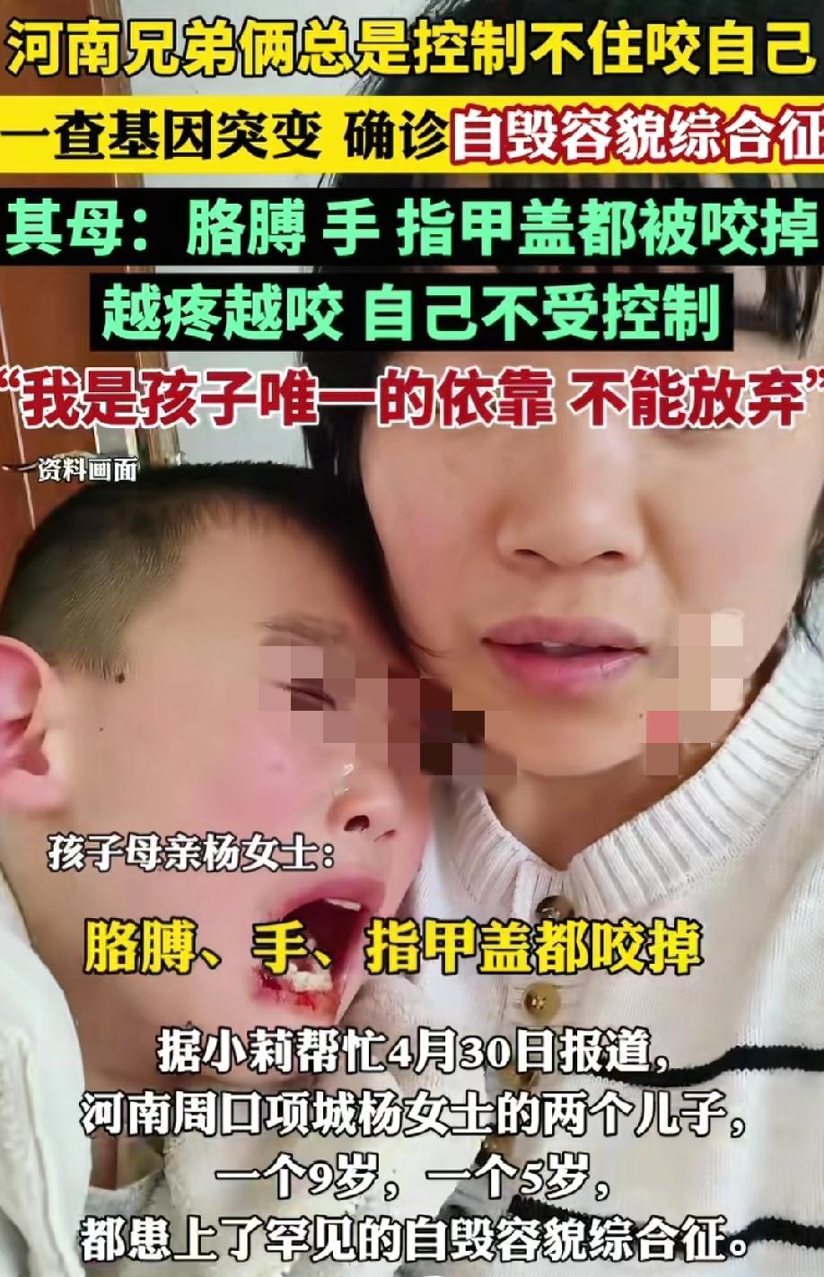 听说过“自毁容貌综合症”吗？
它的发病率是38万分之一，而且几乎所有的患儿都是男