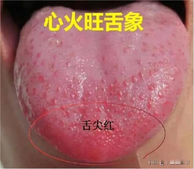 人有3火睡不好，教你一招灭三火，一觉到天亮
1.心火
心主神明，心火太旺，扰动心