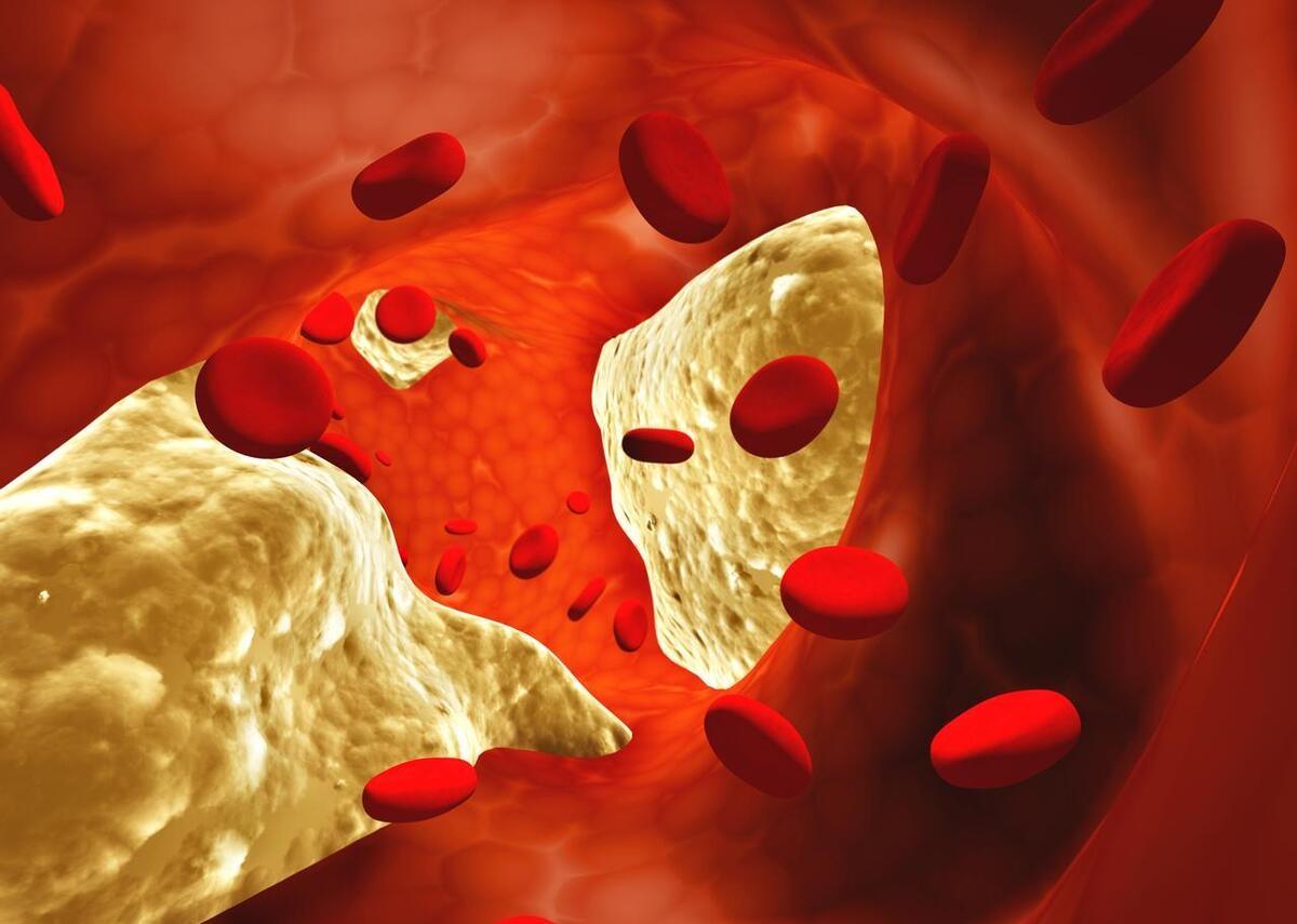 脑梗、腔梗，是不是一回事呢？
造成脑梗塞的主要原因有两种，一种原因是颈部动脉或是