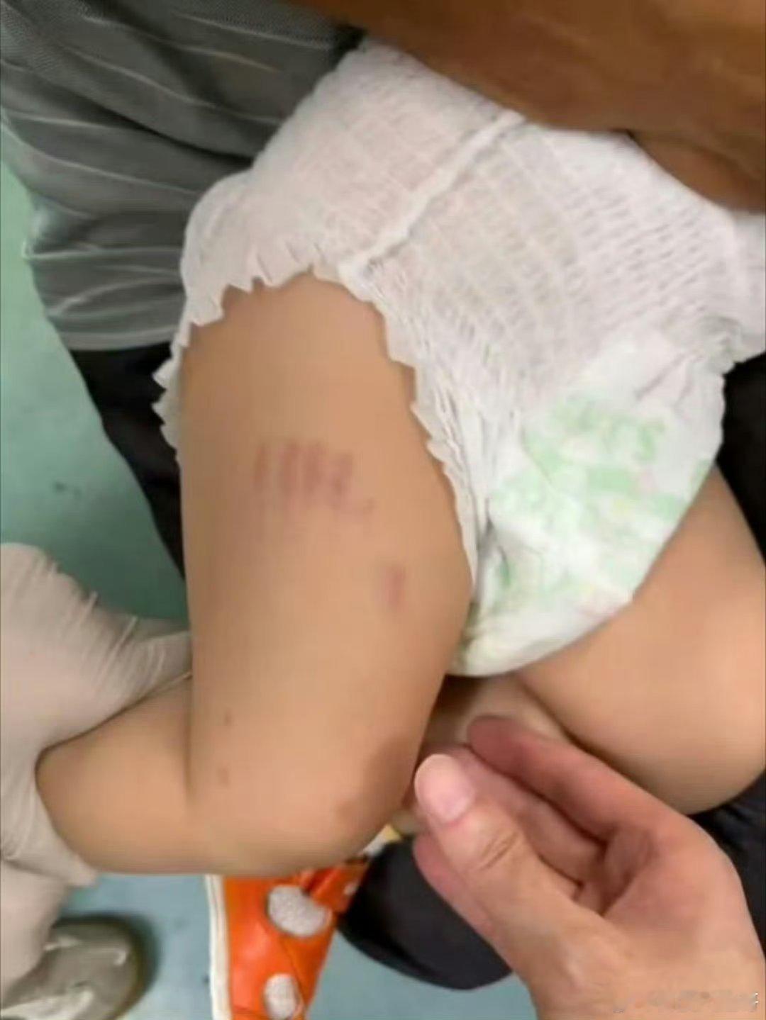 苏州遛狗不拴绳咬伤两名幼童8月22日傍晚，苏州某小区空地上，俩穿尿不湿的幼童正玩