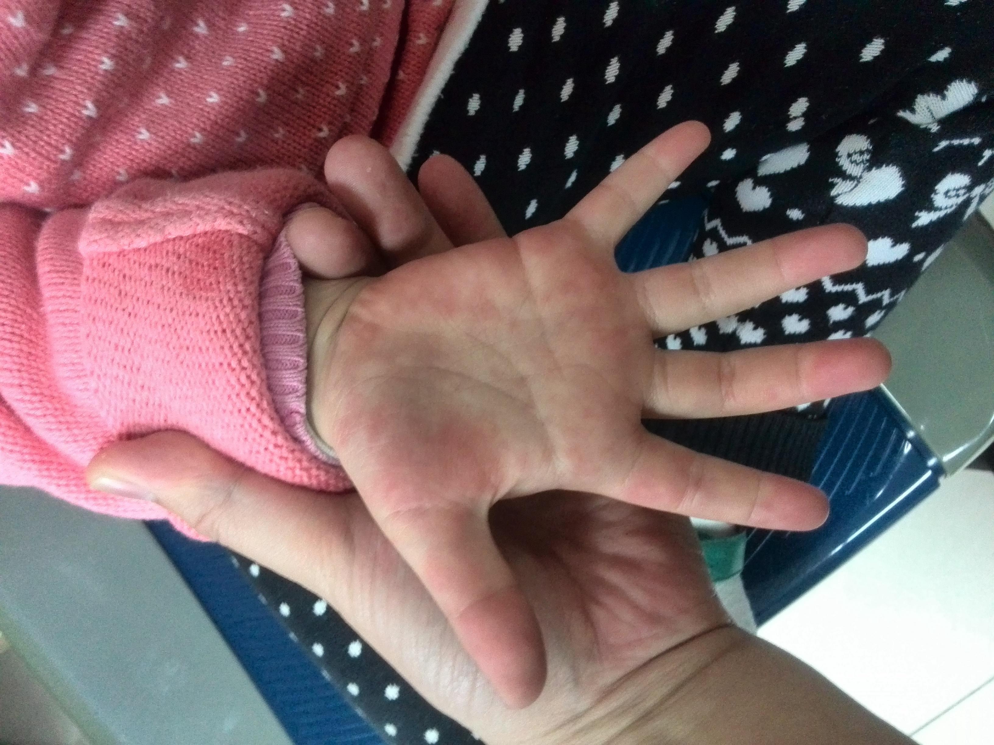 儿童健康守护者计划#  每年4-7月份是手足口病的高发期，儿童手足口病如何预防？