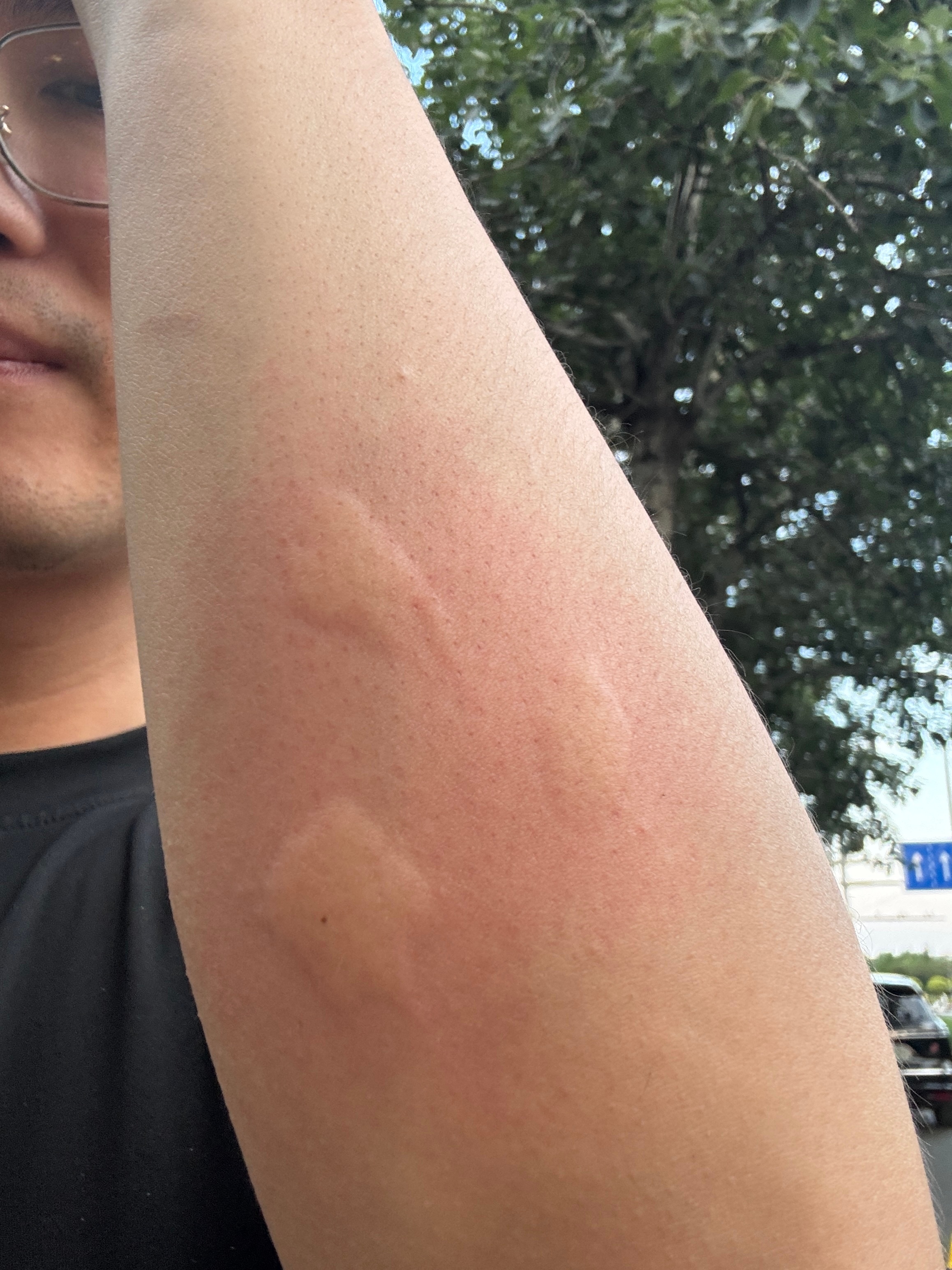 今年蚊子是变异了吗？我下车不到一分钟，同一个位置被咬了三口。 