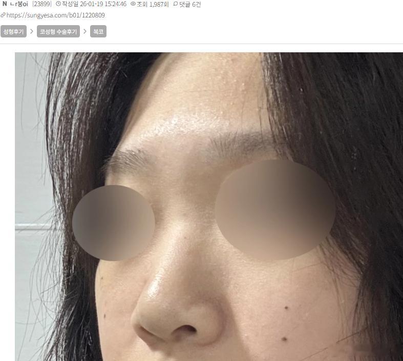 虽然现在很多营销号都在说“国内鼻子已经全面超越韩国”，但我觉得多少是有点夸张。韩