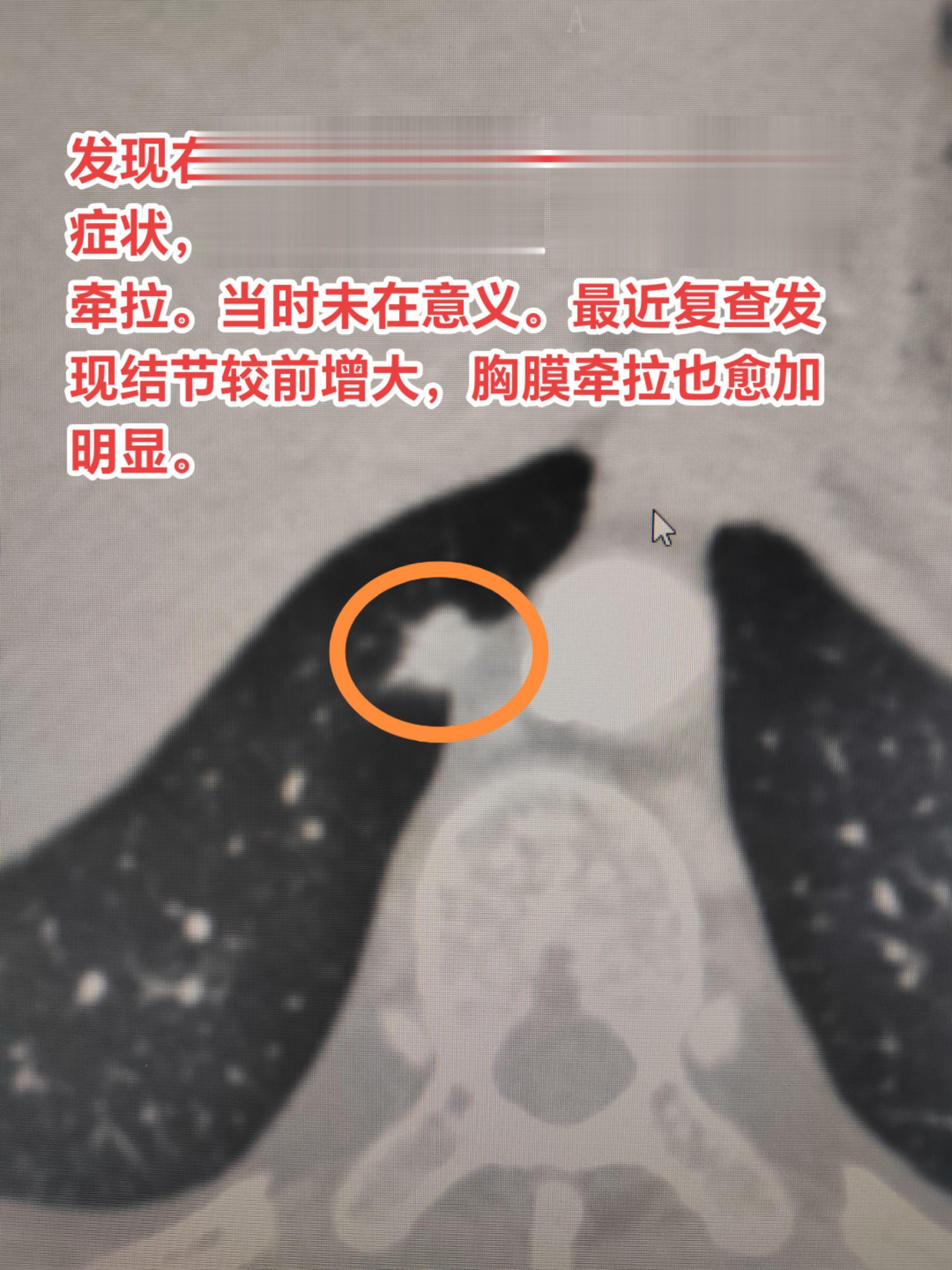 靠近胸膜的实性结节如怀疑恶性需要尽早处理。发现右下肺实性结节一年，无任...