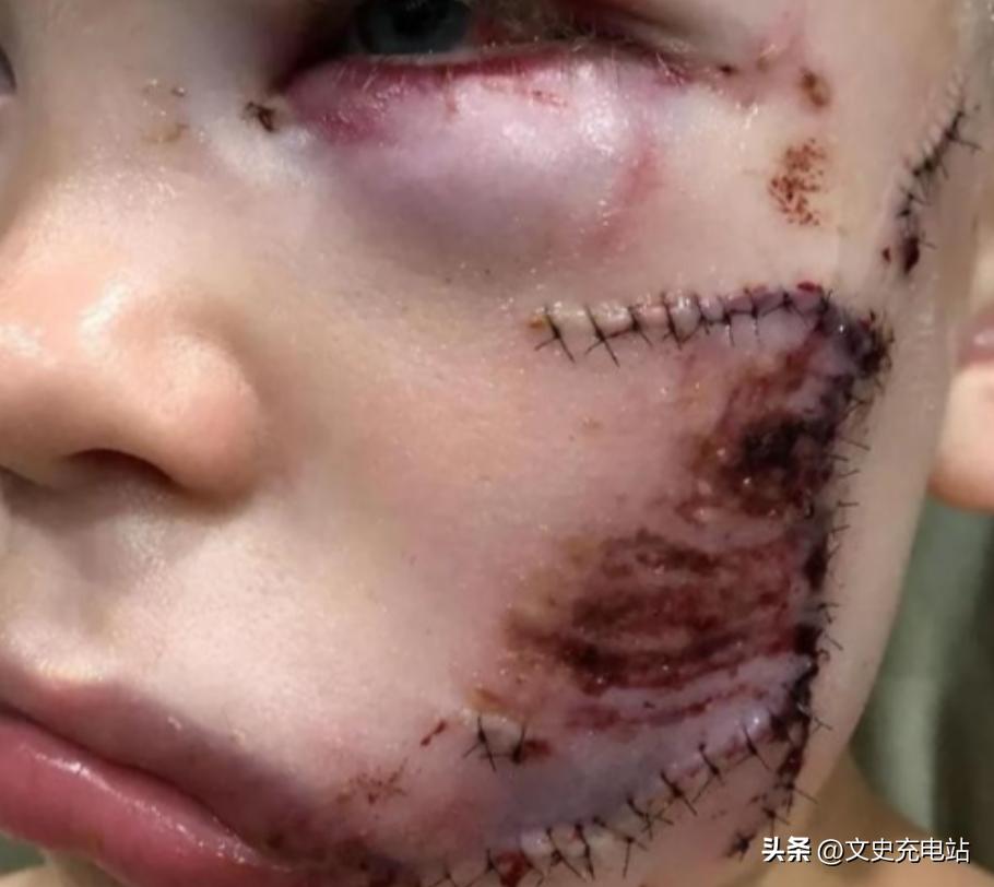 2020年，这个小男孩从一只牧羊犬口中救出了他的小妹妹，他头脸一共缝了90针，但