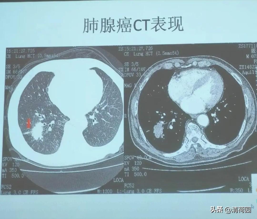 但说真的，一根半厘米的小辣子能在肺里演得比真癌还像真癌，这事本身就在提醒我们：吃