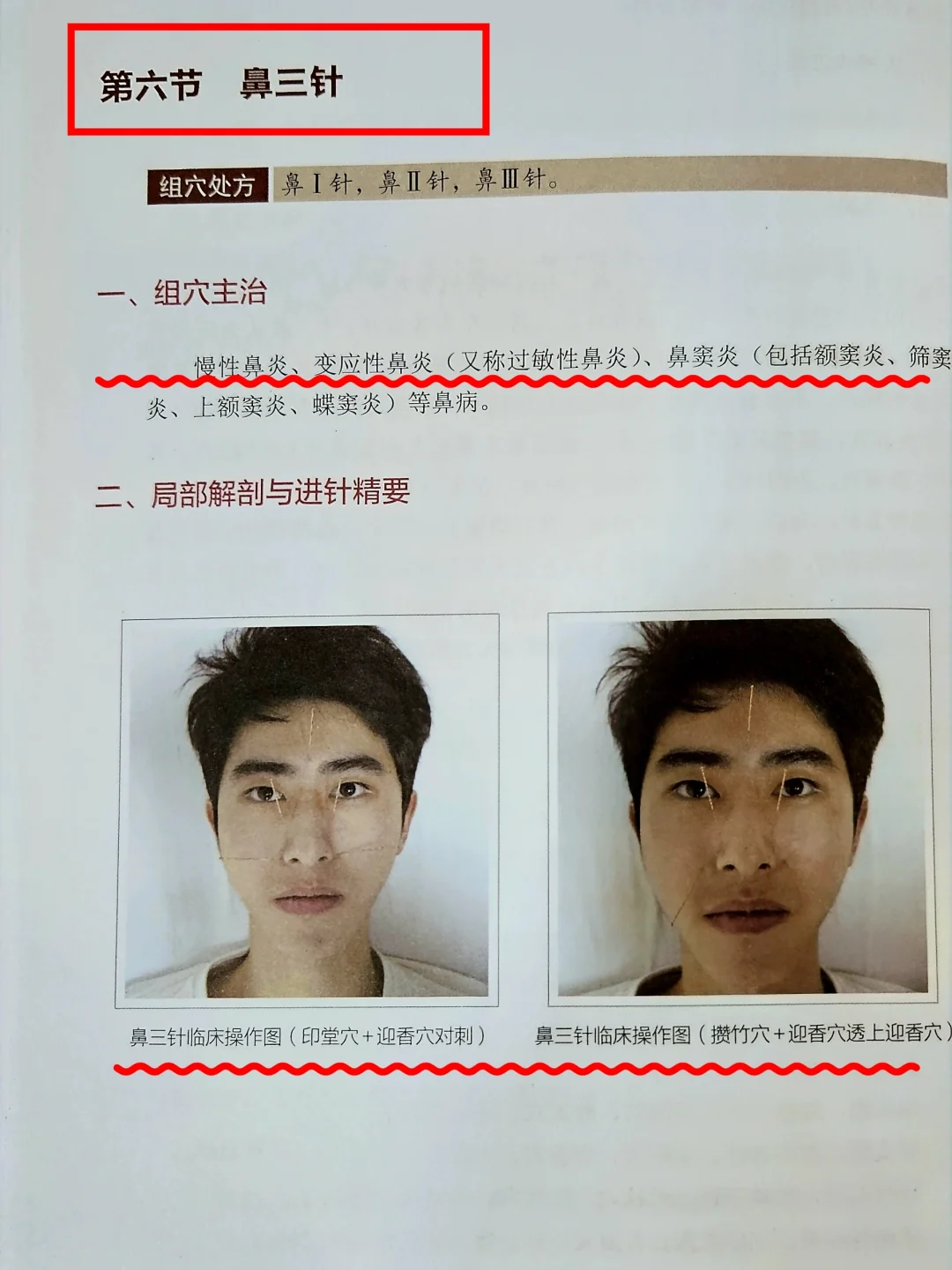 一个简易针灸鼻炎方，用力按压按亦可取消