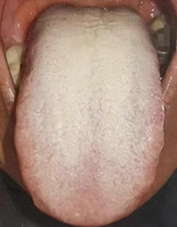 舌瘦长淡白 + 厚腻苔，还舌边鼓胀舌中凹？这是气血、肝、脾、肾全 “弱” 了，越