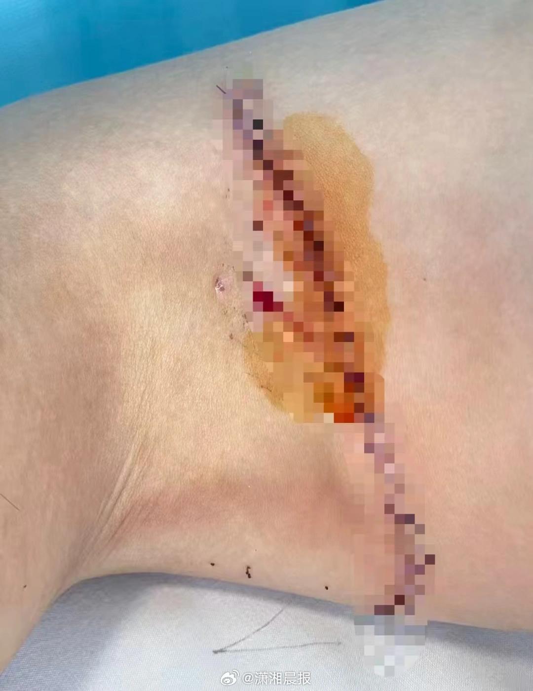 【#医院水池碎裂致男童大腿肌腱断裂#，#多方回应医院水池碎裂致男童受伤#】近日，