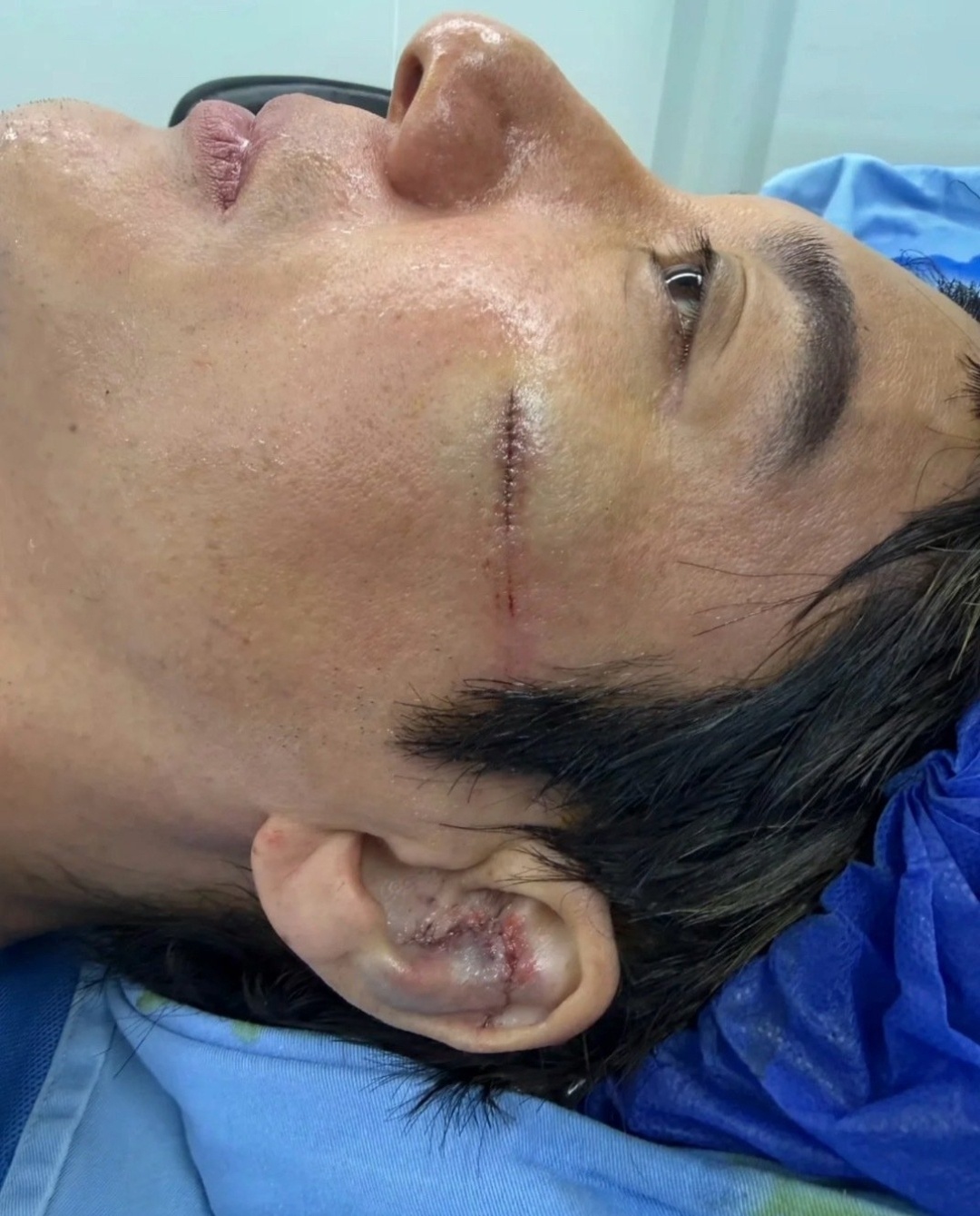王力宏伤得比想象中的要严重。我之前看视频，觉得可能只是重重地栽了个跟头。但是按照