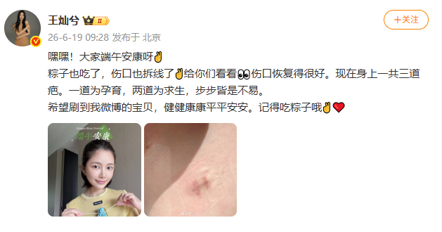 【王灿伤口拆线】王灿身上3道疤1道孕育2道求生 6月19日，发文：嘿嘿!大家端午