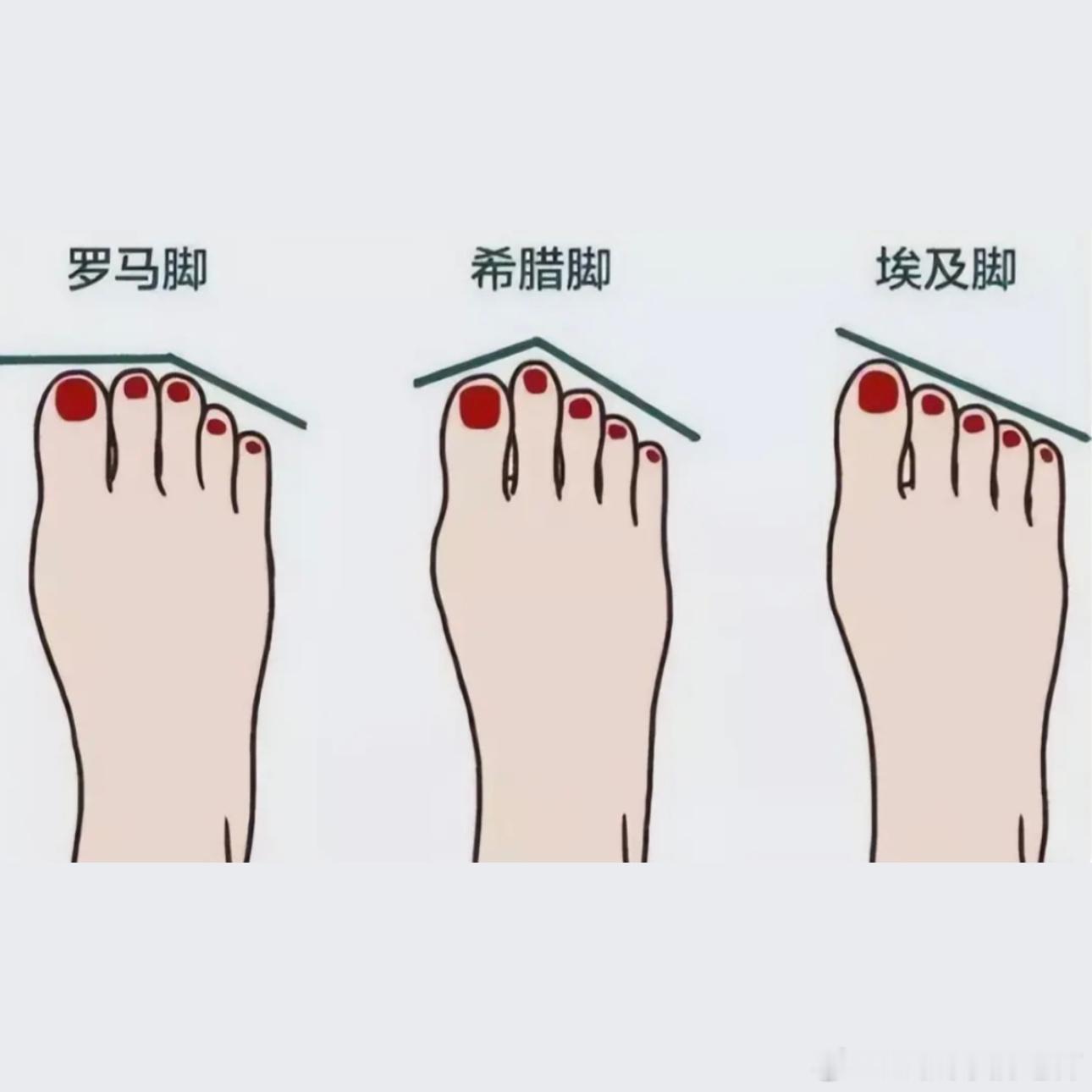 #足弓塌陷# 康复训练中常见的便是脚了，而脚趾头的长度和轮廓，也会影响你的前脚掌