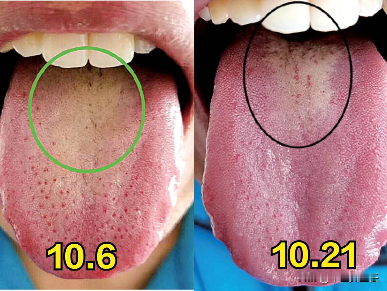 舌苔特别厚的地方就是病！
为什么这么说呢？来看这个粉丝舌象：

唯独舌根苔又厚又