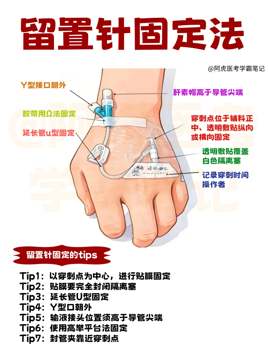 医学生笔记📒：留置针固定方法👆
